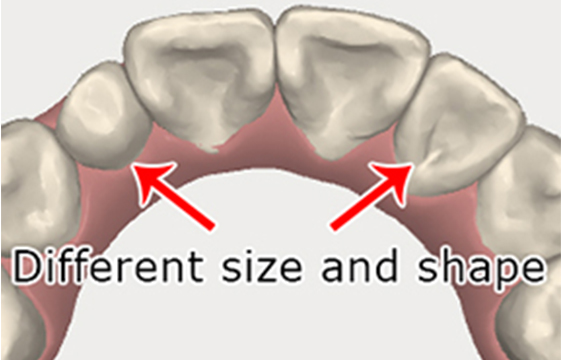 Manhattan Bridge Orthodontics Size and Shape of teeth