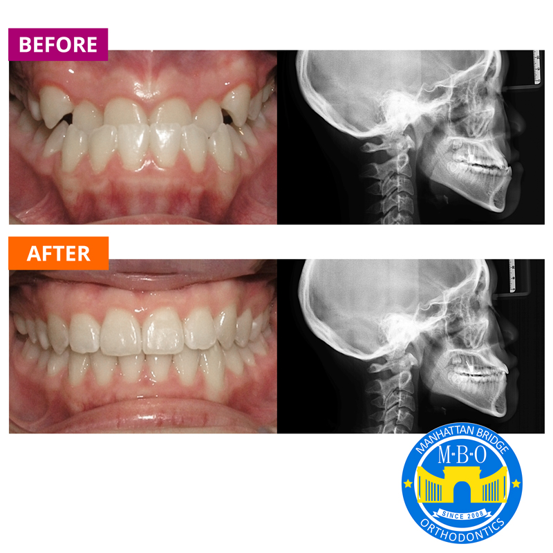 Manhattan Bridge Orthodontics Before and After results