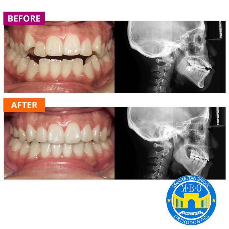 Manhattan Bridge Orthodontics Before and After results