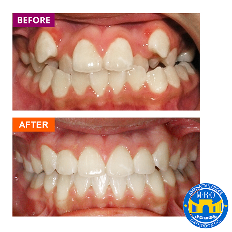 invisalign before and after crossbite