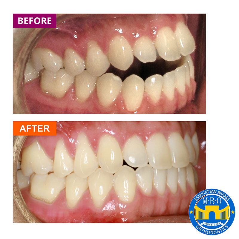 Manhattan Bridge Orthodontics Before and After results