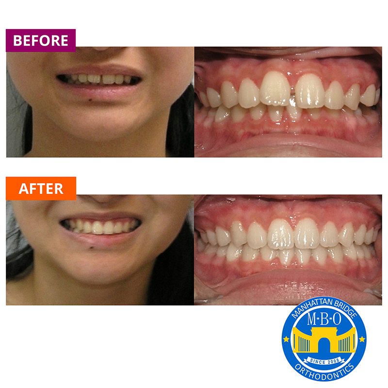 Invisalign Clear Braces Treatment for gap teeth in NYCDr. Jacquie