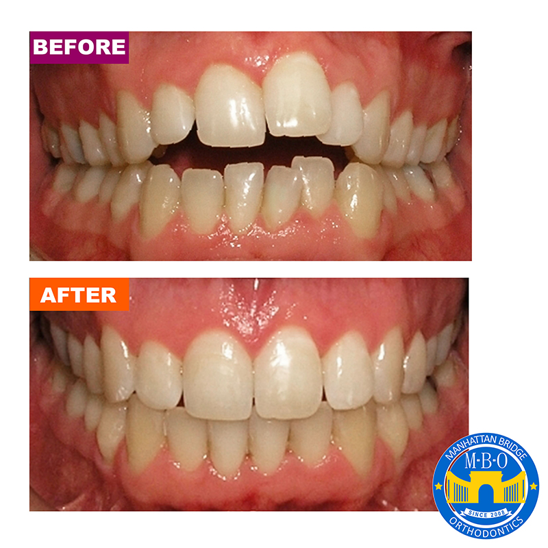 Manhattan Bridge Orthodontics Before and After results