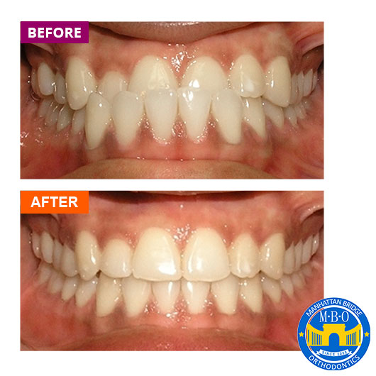 Before and After Cases Treated at Manhattan Bridge Orthodontics ...