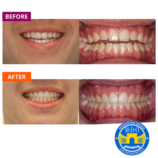 Before and After Cases Treated at Manhattan Bridge Orthodontics ...