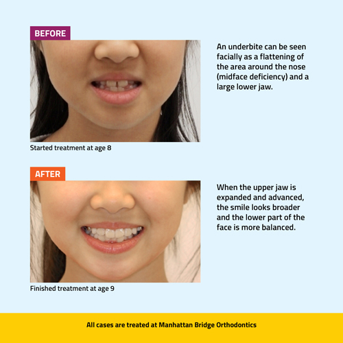 Manhattan Bridge Orthodontics Underbite Phase 1 before & after