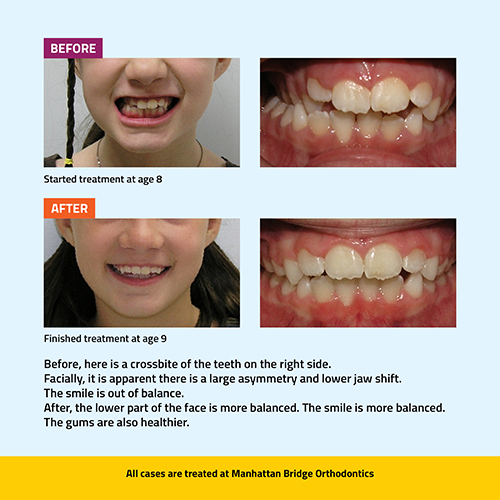 Manhattan Bridge Orthodontics Before and After results