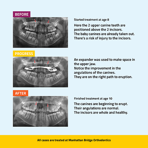 Manhattan Bridge Orthodontics Phase 1 Before and After results