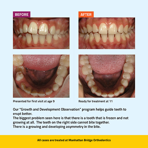 Manhattan Bridge Orthodontics "Growth and Development Observation" Program Before and After results