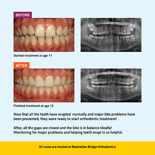 Manhattan Bridge Orthodontics Phase 1 Before and After results