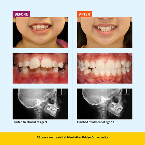 Manhattan Bridge Orthodontics Before and After results