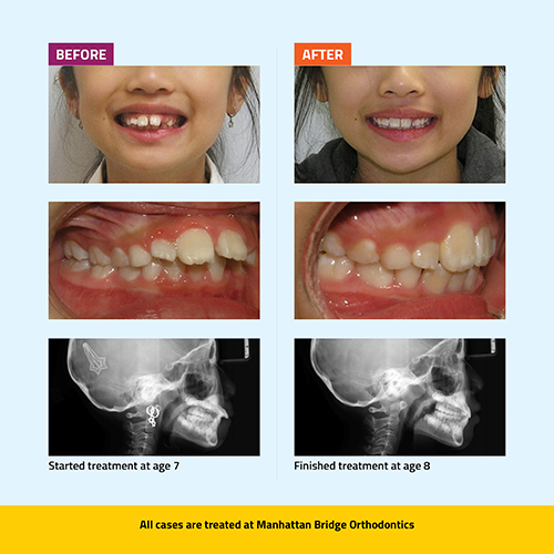 Manhattan Bridge Orthodontics Before and After results