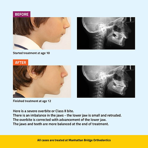 Manhattan Bridge Orthodontics Before and After results