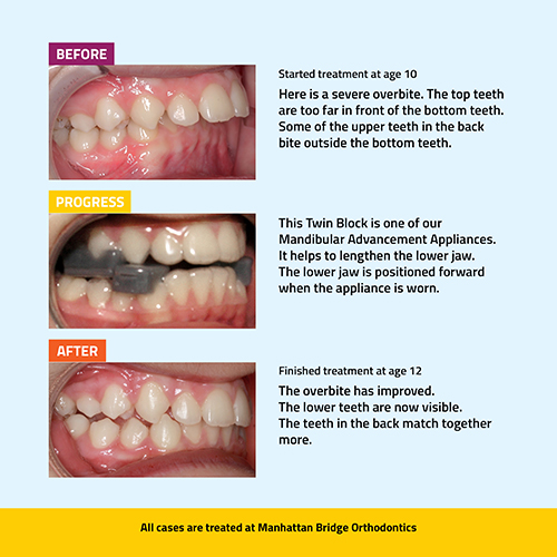 Manhattan Bridge Orthodontics Before, Progress and After results