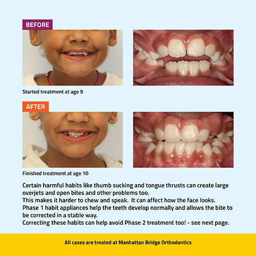 Manhattan Bridge Orthodontics Open Bite Phase 1 before and after