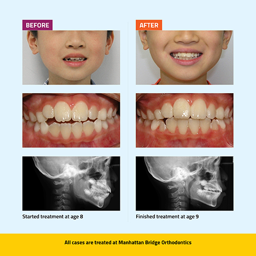 Manhattan Bridge Orthodontics Before and After results