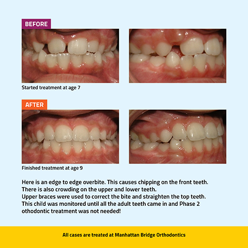 Manhattan Bridge Orthodontics Edge to Edge Overbite Phase 1 before and after