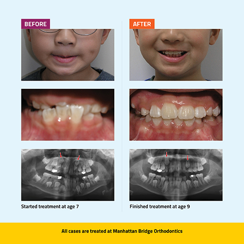 Manhattan Bridge Orthodontics Phase 1 Before and After results