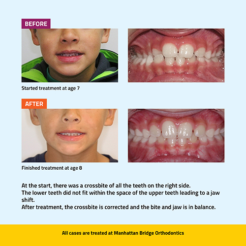 Manhattan Bridge Orthodontics Before and After results