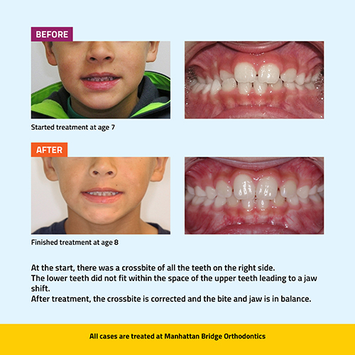 braces before and after open bite