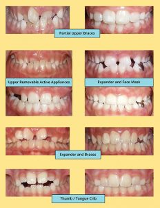 Phase 1 Interceptive Treatment | Manhattan Bridge Orthodontics