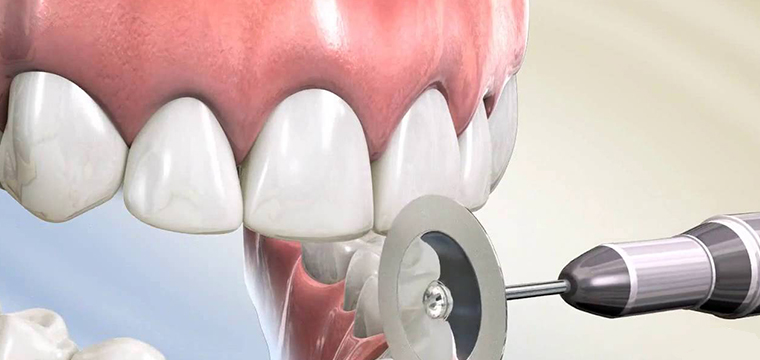 Orthodontic Burs for IPR & Invisalign