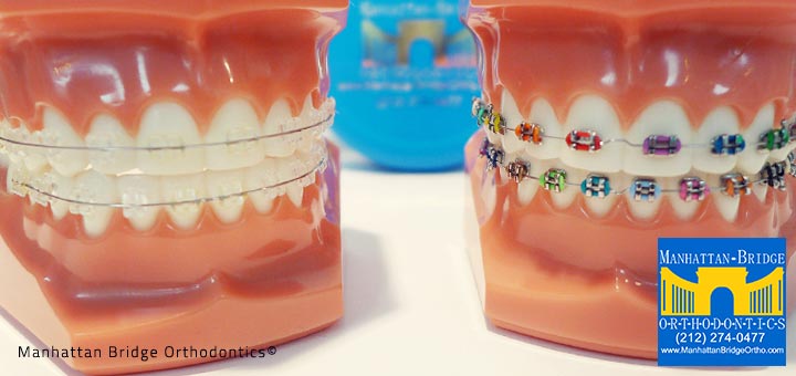 Braces Treatment Process | Manhattan Bridge Orthodontics