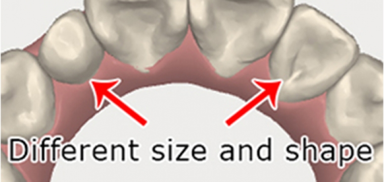 Manhattan Bridge Orthodontics Size and Shape of teeth