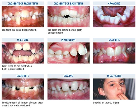 Phase 1 Early Treatment | Manhattan Bridge Orthodontics